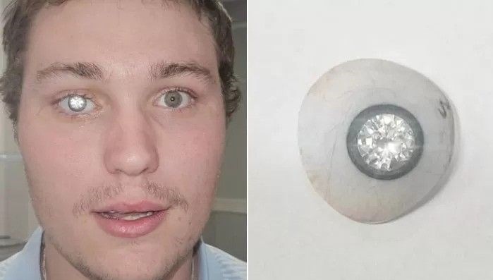 abdli kuyumcu goz protezine 2 karatlik elmas yerlestirdi 6lr7NwNI.jpg